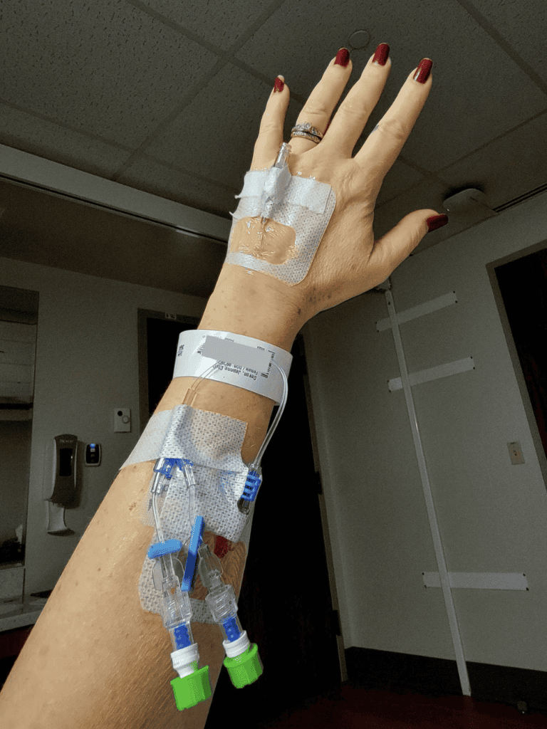 A woman holding her arm up filled with IV ports and tubes taped on